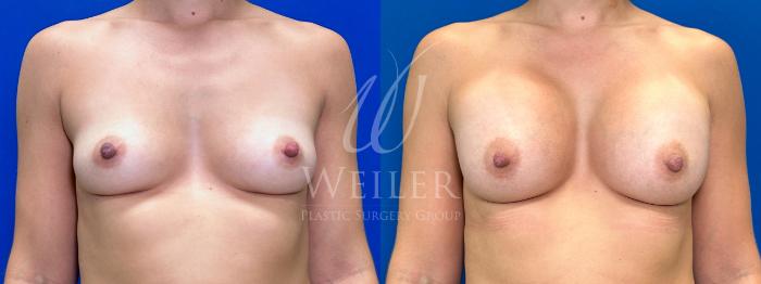 Before & After Breast Augmentation Case 1551 Front View in Baton Rouge, New Orleans, & Lafayette, Louisiana