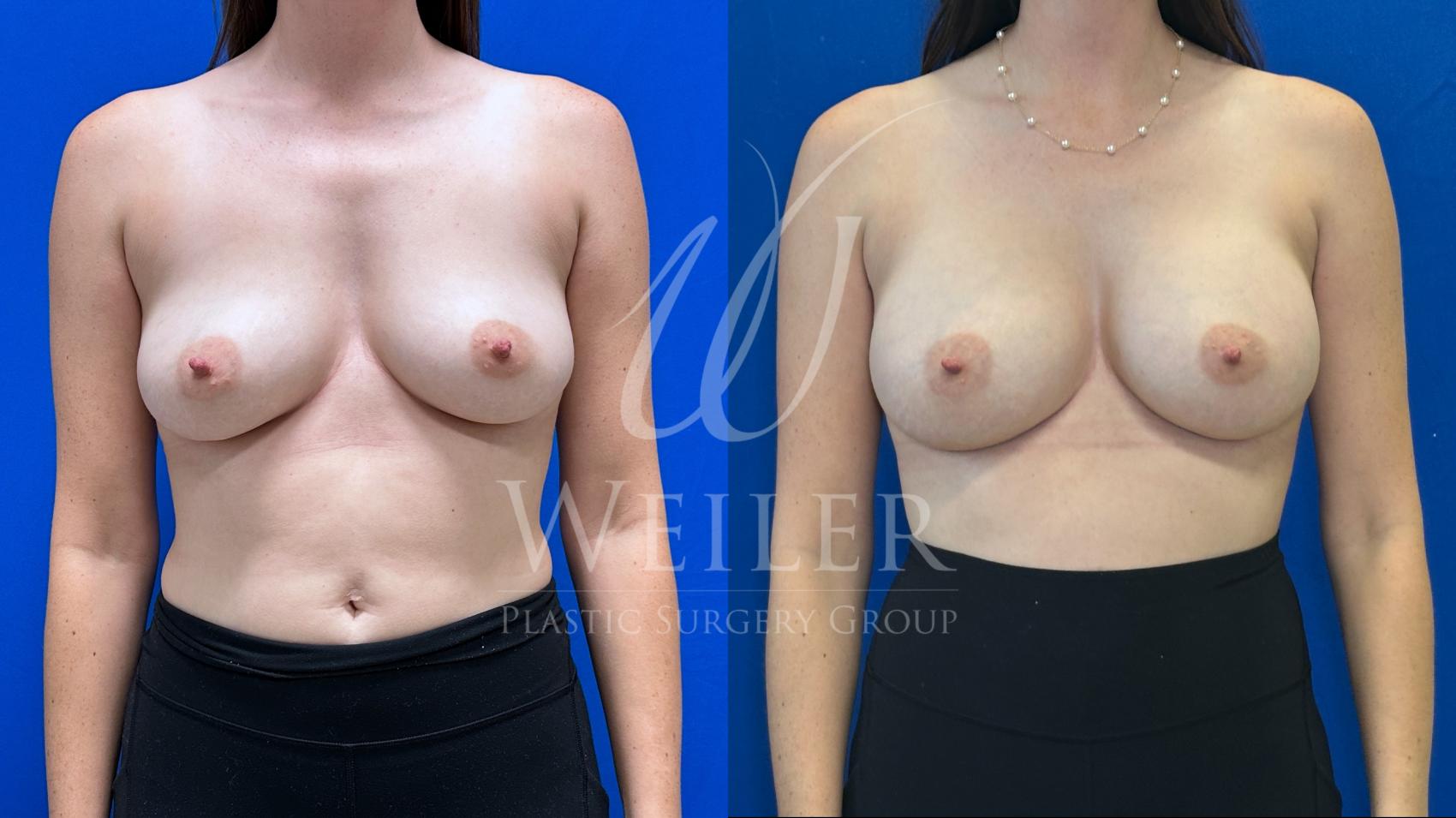 Before & After Breast Augmentation Case 1567 Front View in Baton Rouge, New Orleans, & Lafayette, Louisiana