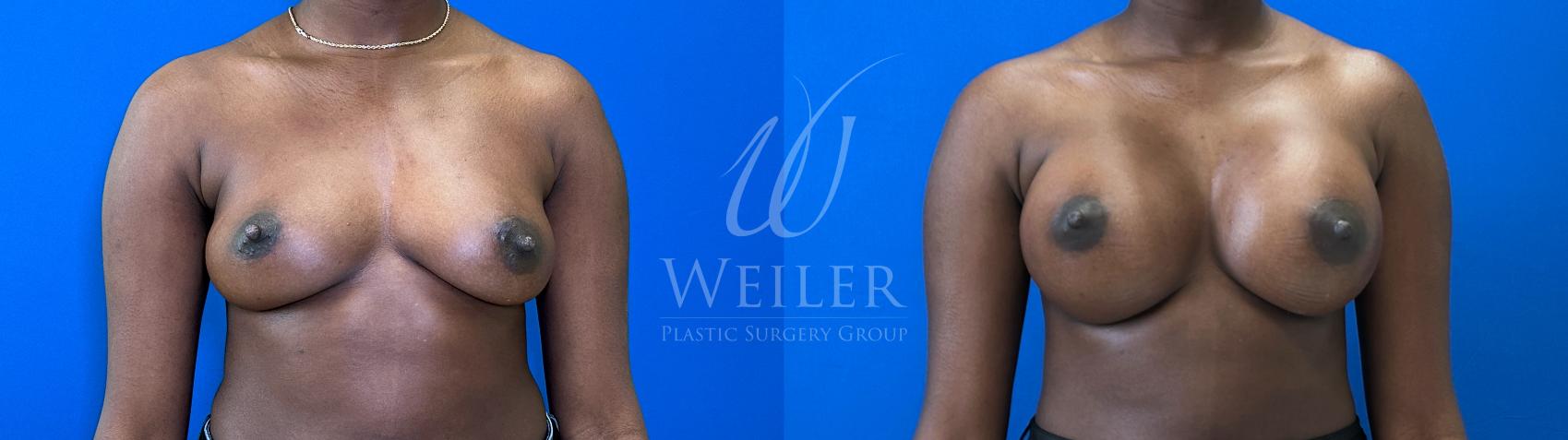 Before & After Breast Augmentation Case 1577 Front View in Baton Rouge, New Orleans, & Lafayette, Louisiana