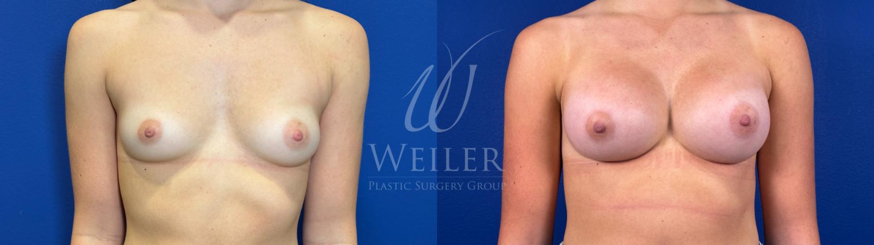 Before & After Breast Augmentation Case 1579 Front View in Baton Rouge, New Orleans, & Lafayette, Louisiana