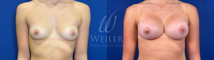 Before & After Breast Augmentation Case 1579 Front View in Baton Rouge, New Orleans, & Lafayette, Louisiana