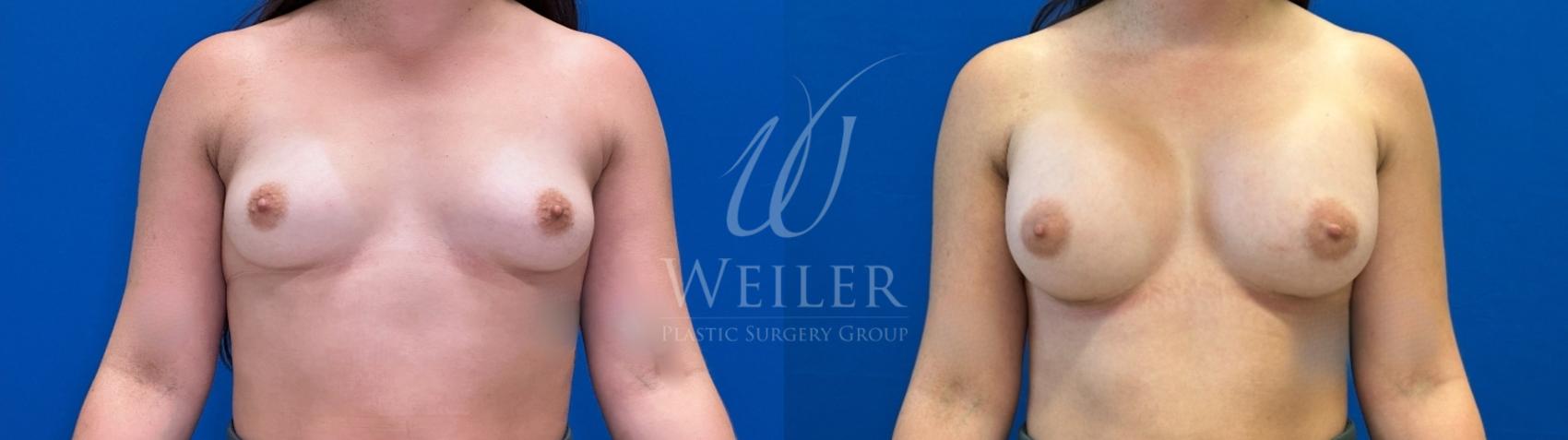 Before & After Breast Augmentation Case 1580 Front View in Baton Rouge, New Orleans, & Lafayette, Louisiana