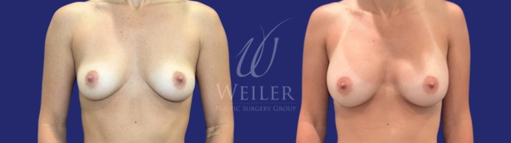 Before & After Breast Augmentation Case 1589 Front View in Baton Rouge, New Orleans, & Lafayette, Louisiana