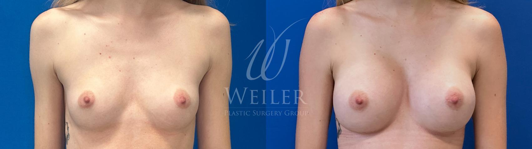 Before & After Breast Augmentation Case 1594 Front View in Baton Rouge, New Orleans, & Lafayette, Louisiana