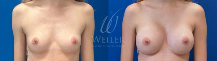 Before & After Breast Augmentation Case 1594 Front View in Baton Rouge, New Orleans, & Lafayette, Louisiana