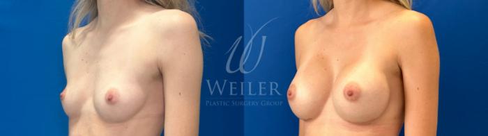 Before & After Breast Augmentation Case 1594 Left Oblique View in Baton Rouge, New Orleans, & Lafayette, Louisiana
