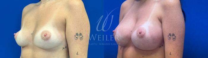 Before & After Breast Augmentation Case 1597 Left Oblique View in Baton Rouge, New Orleans, & Lafayette, Louisiana