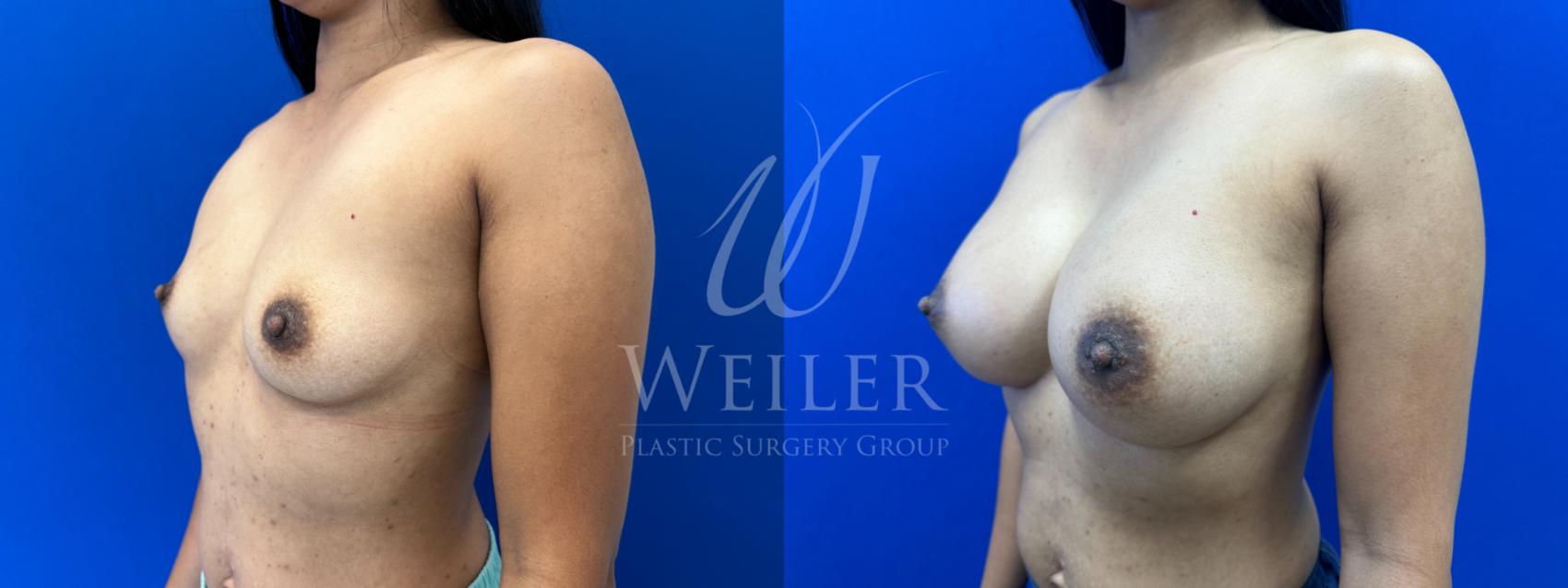 Before & After Breast Augmentation Case 1599 Left Oblique View in Baton Rouge, New Orleans, & Lafayette, Louisiana