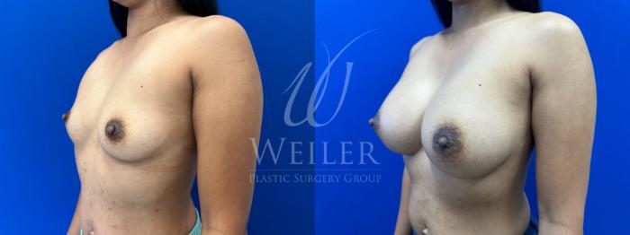 Before & After Breast Augmentation Case 1599 Left Oblique View in Baton Rouge, New Orleans, & Lafayette, Louisiana