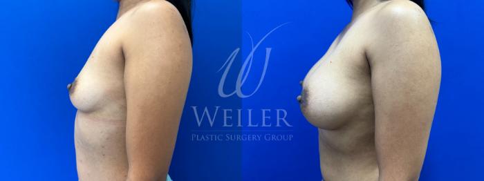 Before & After Breast Augmentation Case 1599 Left Side View in Baton Rouge, New Orleans, & Lafayette, Louisiana