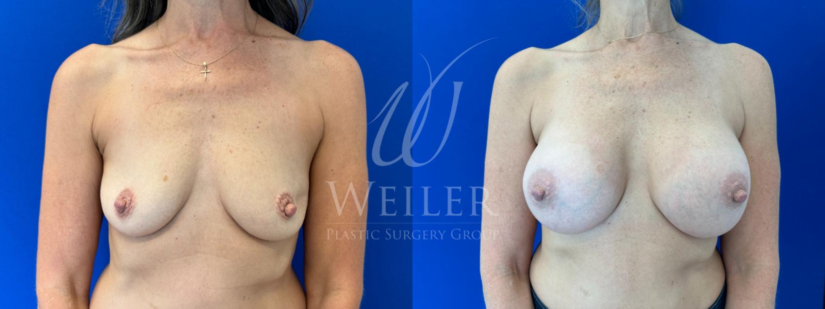 Before & After Breast Augmentation Case 1615 Front View in Baton Rouge, New Orleans, & Lafayette, Louisiana