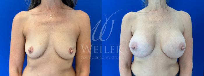 Before & After Breast Augmentation Case 1615 Front View in Baton Rouge, New Orleans, & Lafayette, Louisiana