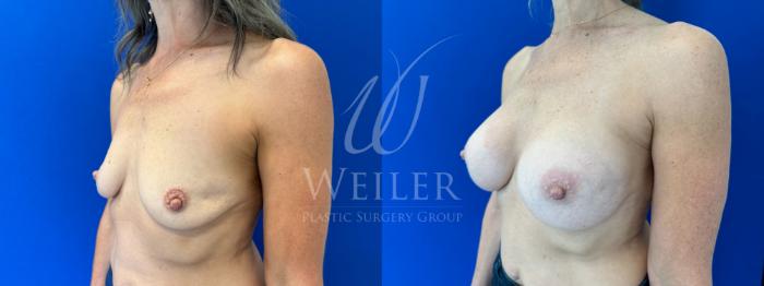 Before & After Breast Augmentation Case 1615 Left Oblique View in Baton Rouge, New Orleans, & Lafayette, Louisiana