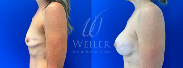 Before & After Breast Augmentation Case 1615 Left Side View in Baton Rouge, New Orleans, & Lafayette, Louisiana