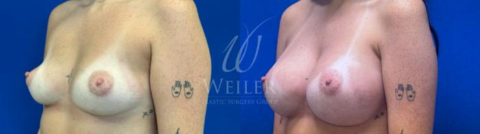 Before & After Breast Augmentation Case 1616 Left Oblique View in Baton Rouge, New Orleans, & Lafayette, Louisiana