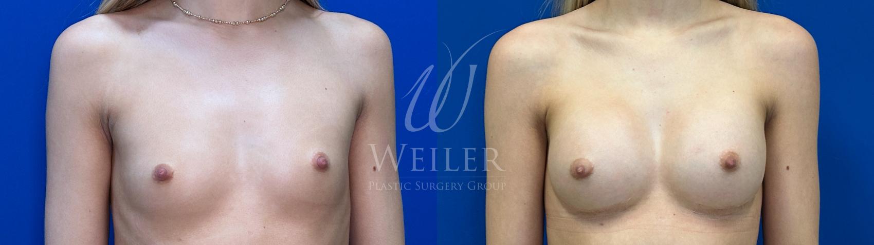 Before & After Breast Augmentation Case 1621 Front View in Baton Rouge, New Orleans, & Lafayette, Louisiana