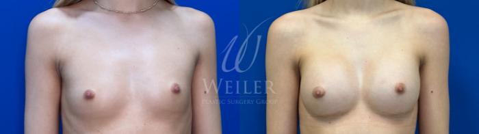Before & After Breast Augmentation Case 1621 Front View in Baton Rouge, New Orleans, & Lafayette, Louisiana