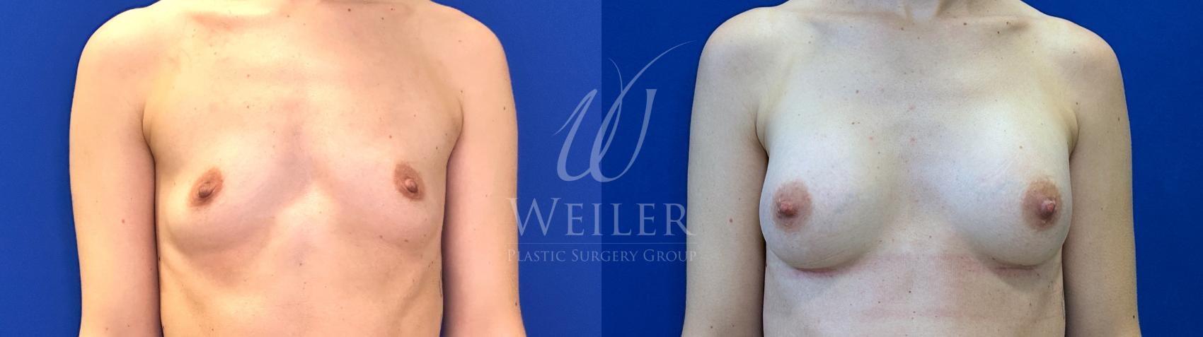 Before & After Breast Augmentation Case 1623 Front View in Baton Rouge, New Orleans, & Lafayette, Louisiana