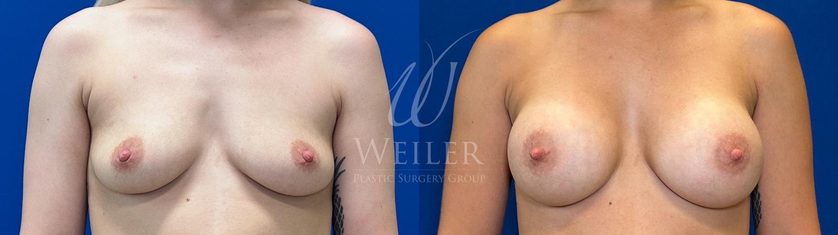 Before & After Breast Augmentation Case 1624 Front View in Baton Rouge, New Orleans, & Lafayette, Louisiana
