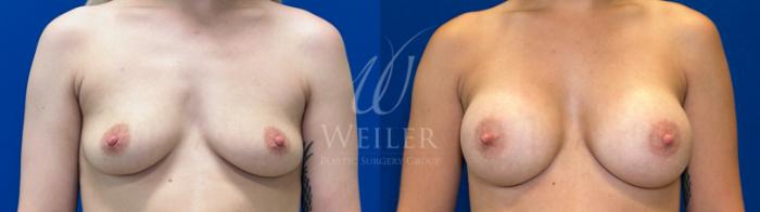 Before & After Breast Augmentation Case 1624 Front View in Baton Rouge, New Orleans, & Lafayette, Louisiana