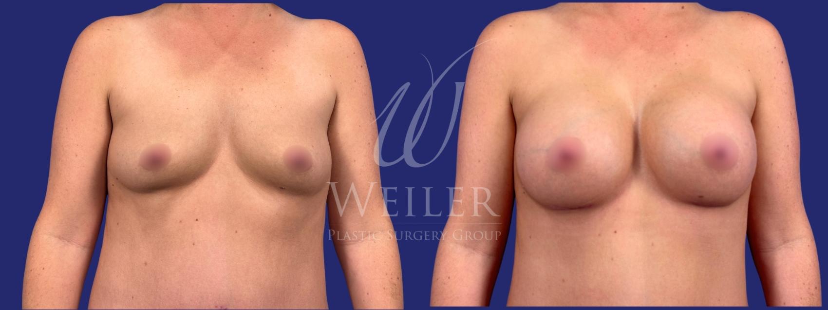 Before & After Breast Augmentation Case 1630 Front View in Baton Rouge, New Orleans, & Lafayette, Louisiana