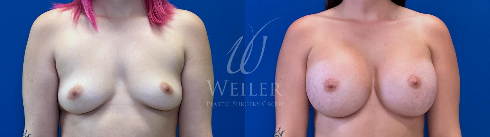 Before & After Breast Augmentation Case 1633 Front View in Baton Rouge, New Orleans, & Lafayette, Louisiana