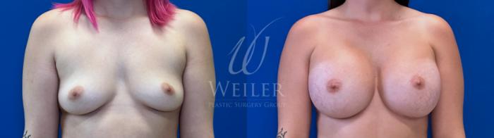 Before & After Breast Augmentation Case 1633 Front View in Baton Rouge, New Orleans, & Lafayette, Louisiana