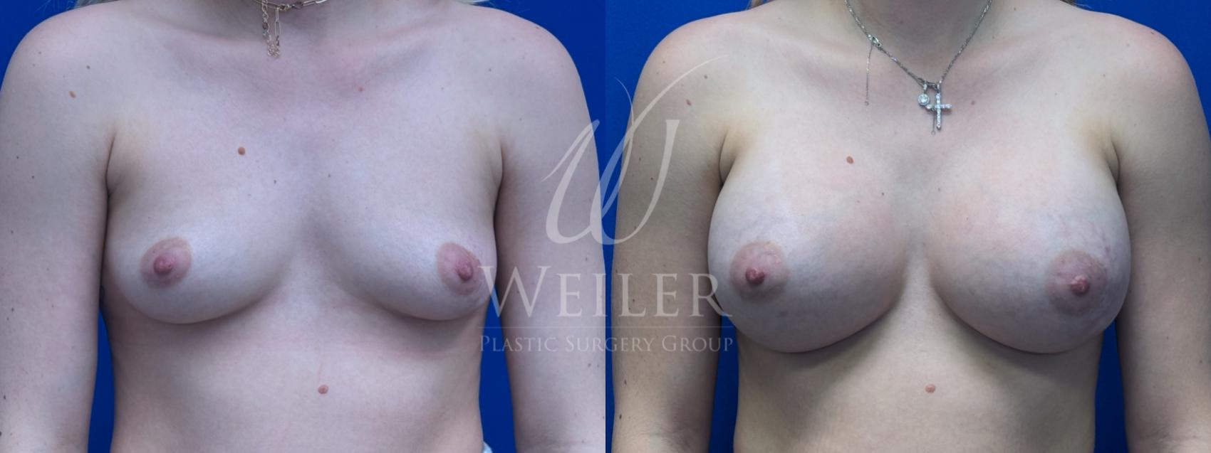 Before & After Breast Augmentation Case 1636 Front View in Baton Rouge, New Orleans, & Lafayette, Louisiana