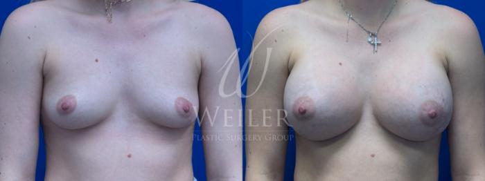 Before & After Breast Augmentation Case 1636 Front View in Baton Rouge, New Orleans, & Lafayette, Louisiana