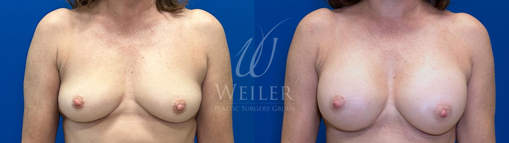 Before & After Breast Augmentation Case 1637 Front View in Baton Rouge, New Orleans, & Lafayette, Louisiana