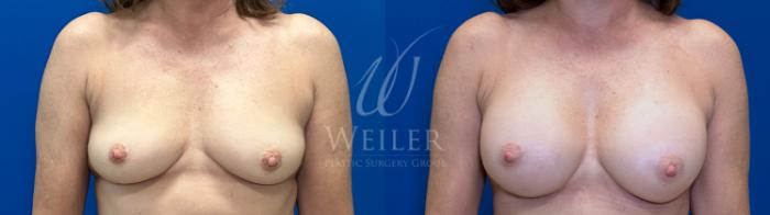 Before & After Breast Augmentation Case 1637 Front View in Baton Rouge, New Orleans, & Lafayette, Louisiana