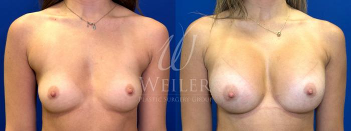 Before & After Breast Augmentation Case 1643 Front View in Baton Rouge, New Orleans, & Lafayette, Louisiana