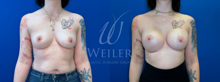 Before & After Breast Augmentation Case 1659 Front View in Baton Rouge, New Orleans, & Lafayette, Louisiana