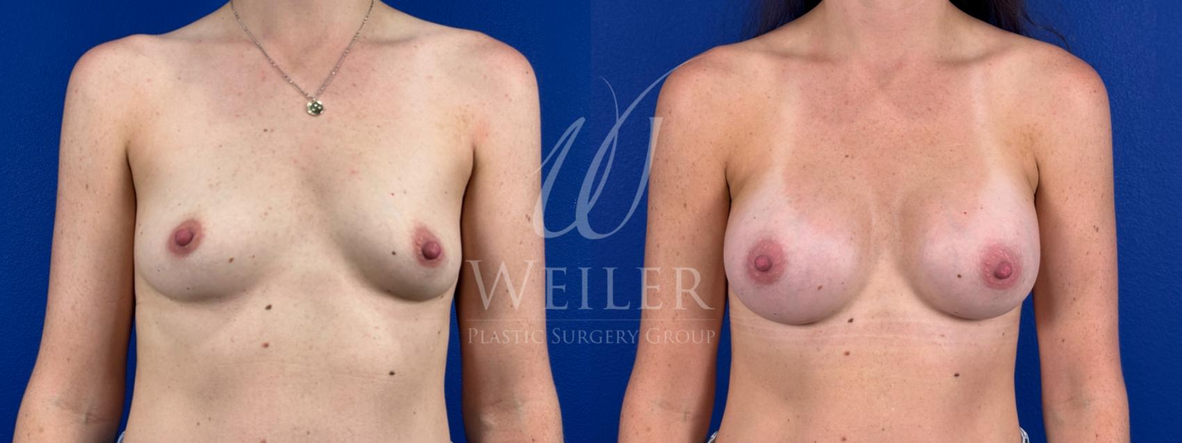 Before & After Breast Augmentation Case 1665 Front View in Baton Rouge, New Orleans, & Lafayette, Louisiana