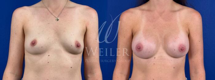 Before & After Breast Augmentation Case 1665 Front View in Baton Rouge, New Orleans, & Lafayette, Louisiana