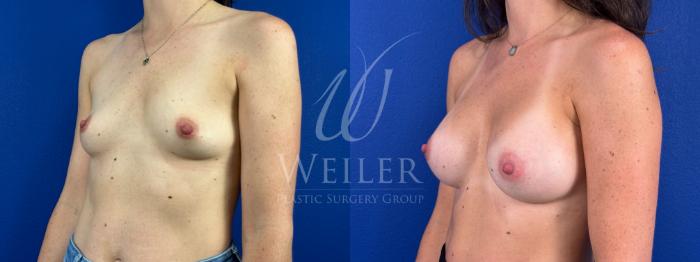 Before & After Breast Augmentation Case 1665 Left Oblique View in Baton Rouge, New Orleans, & Lafayette, Louisiana
