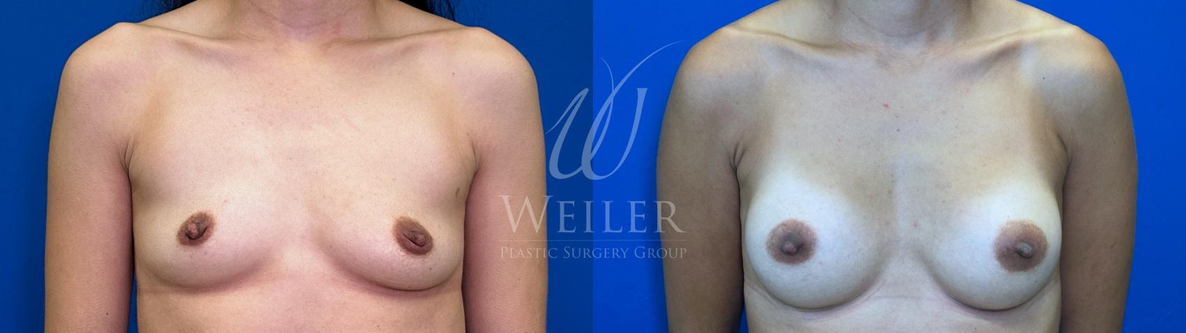 Before & After Breast Augmentation Case 1666 Front View in Baton Rouge, New Orleans, & Lafayette, Louisiana