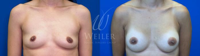 Before & After Breast Augmentation Case 1666 Front View in Baton Rouge, New Orleans, & Lafayette, Louisiana