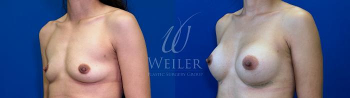 Before & After Breast Augmentation Case 1666 Left Oblique View in Baton Rouge, New Orleans, & Lafayette, Louisiana