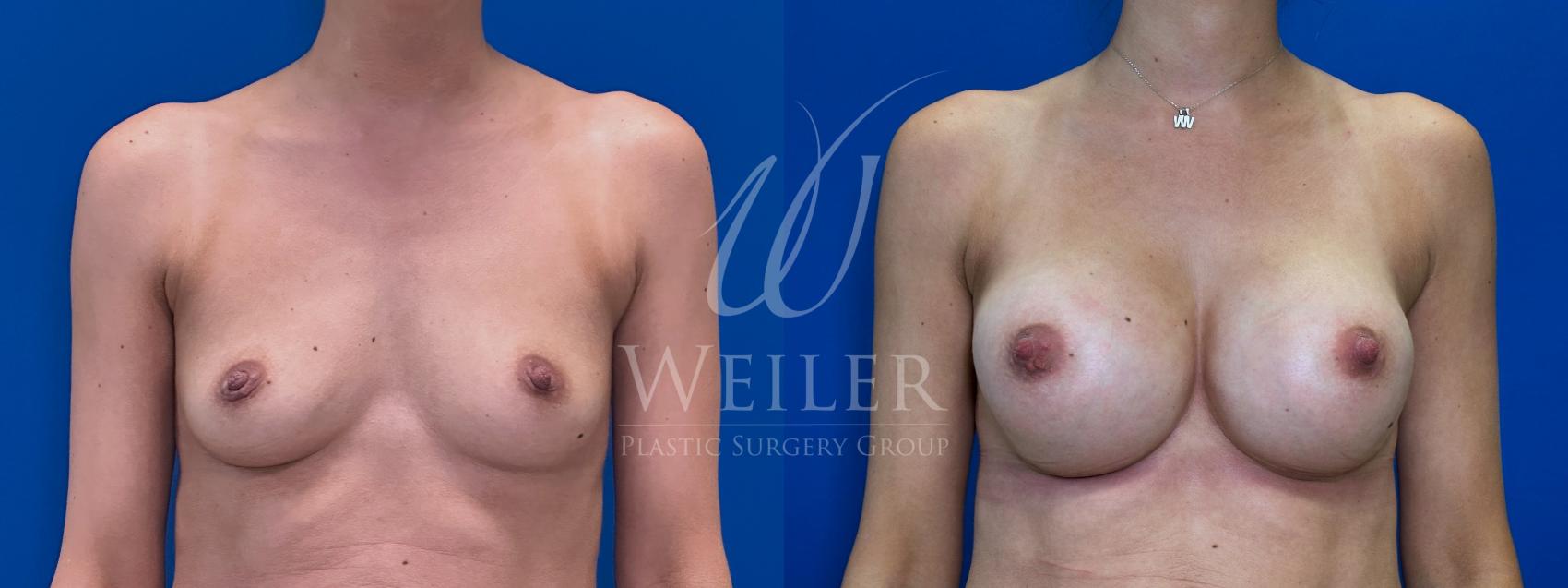 Before & After Breast Augmentation Case 1676 Front View in Baton Rouge, New Orleans, & Lafayette, Louisiana