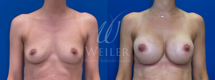 Before & After Breast Augmentation Case 1676 Front View in Baton Rouge, New Orleans, & Lafayette, Louisiana