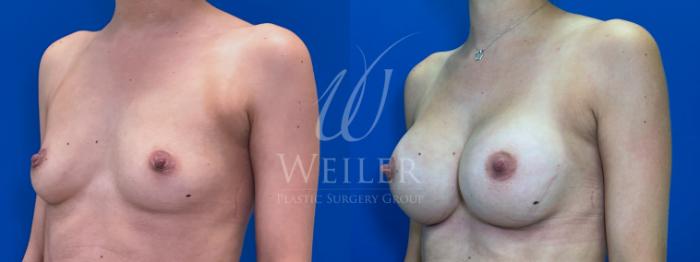Before & After Breast Augmentation Case 1676 Left Oblique View in Baton Rouge, New Orleans, & Lafayette, Louisiana