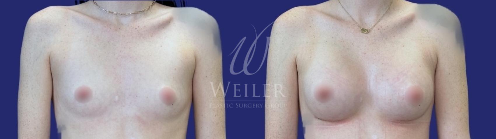 Before & After Breast Augmentation Case 1677 Front View in Baton Rouge, New Orleans, & Lafayette, Louisiana