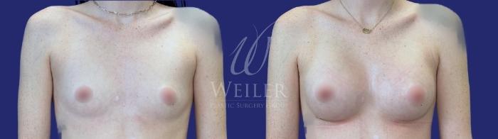 Before & After Breast Augmentation Case 1677 Front View in Baton Rouge, New Orleans, & Lafayette, Louisiana