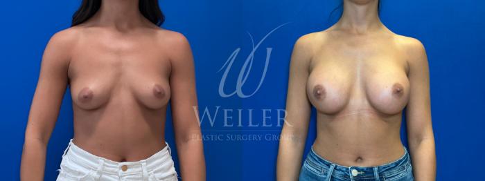 Before & After Breast Augmentation Case 1682 Front View in Baton Rouge, New Orleans, & Lafayette, Louisiana