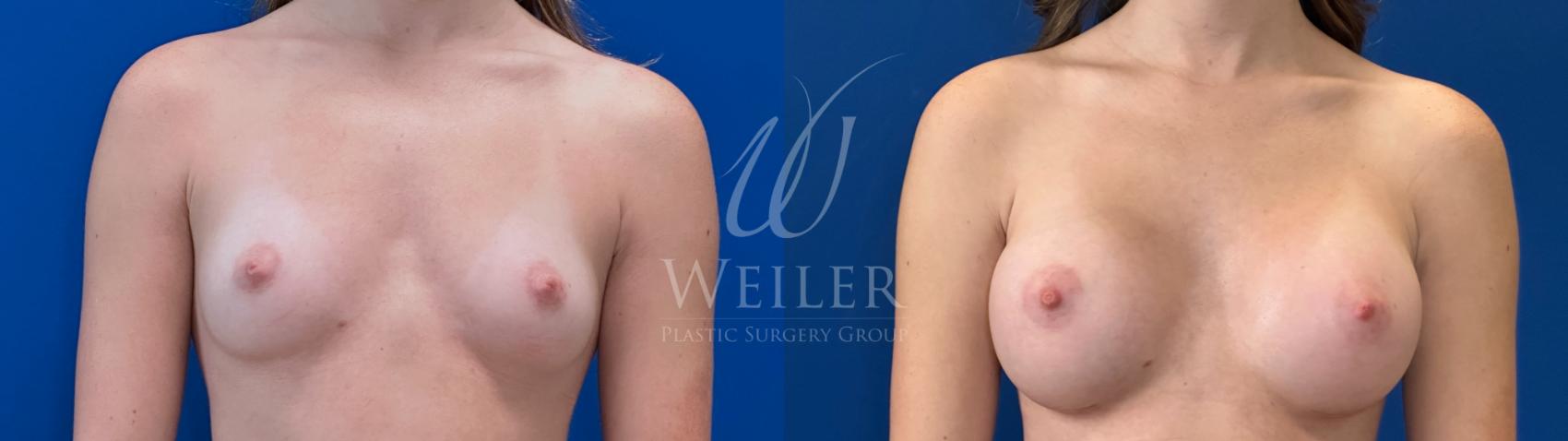 Before & After Breast Augmentation Case 1697 Front View in Baton Rouge, New Orleans, & Lafayette, Louisiana
