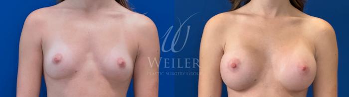 Before & After Breast Augmentation Case 1697 Front View in Baton Rouge, New Orleans, & Lafayette, Louisiana