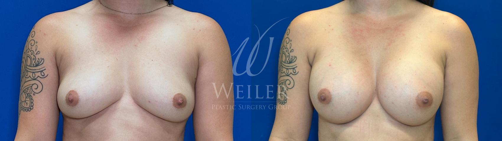 Before & After Breast Augmentation Case 1698 Front View in Baton Rouge, New Orleans, & Lafayette, Louisiana