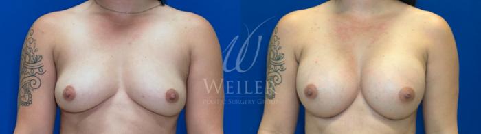 Before & After Breast Augmentation Case 1698 Front View in Baton Rouge, New Orleans, & Lafayette, Louisiana