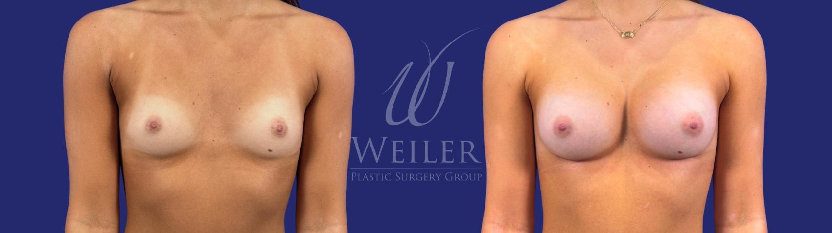Before & After Breast Augmentation Case 1699 Front View in Baton Rouge, New Orleans, & Lafayette, Louisiana